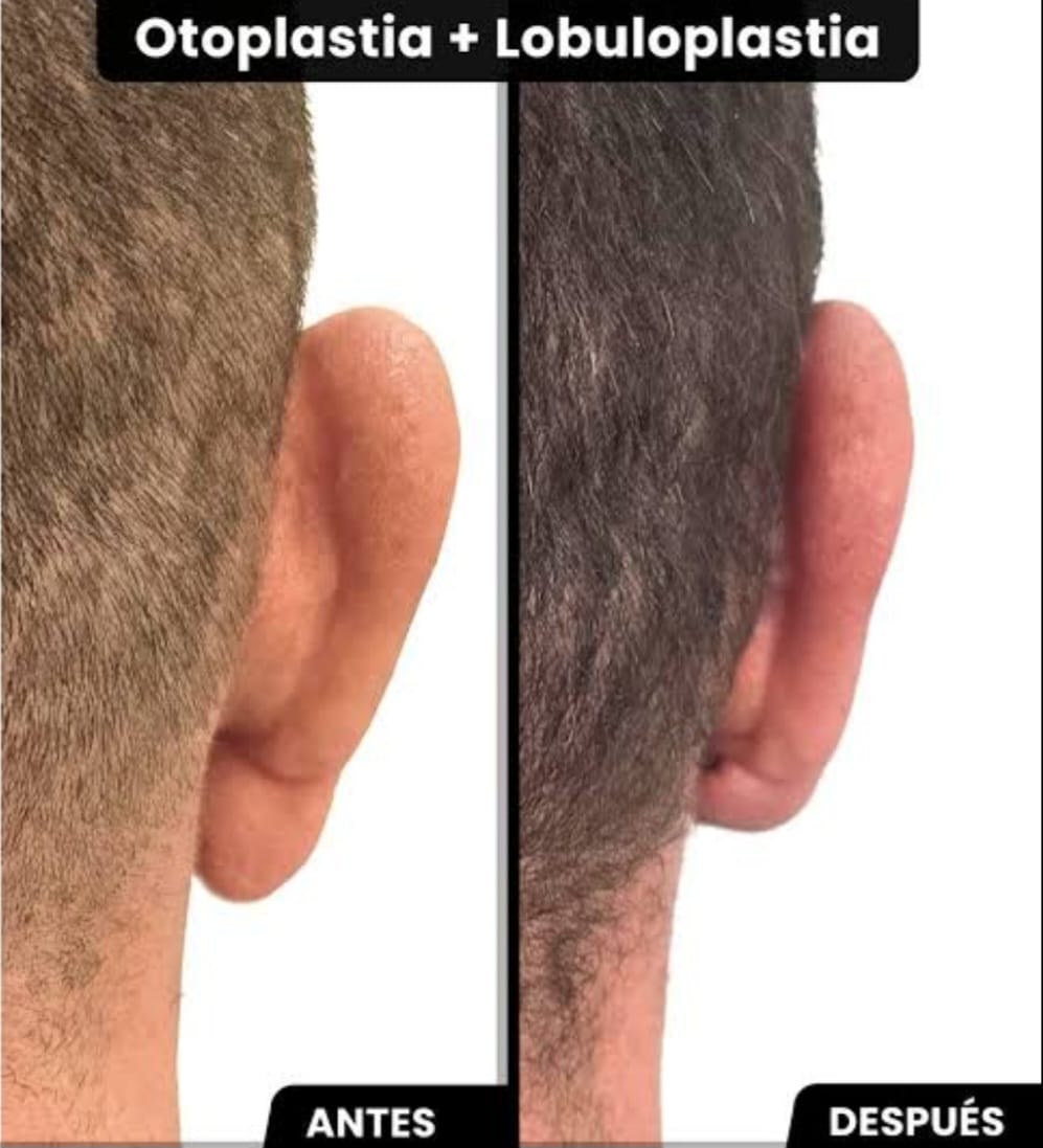 Resultado Otoplastia 3